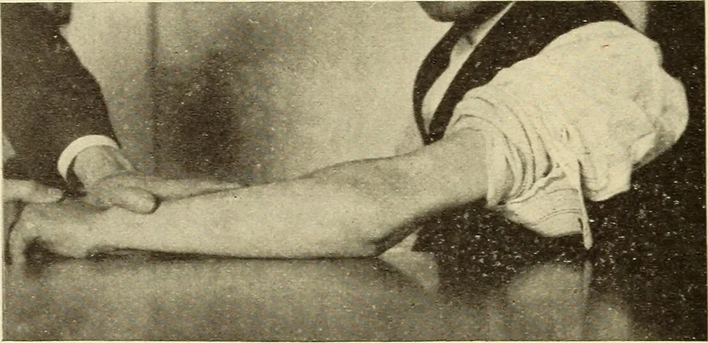 An illustration from Fractures and dislocations, diagnosis and treatment, 1915, leaf 167