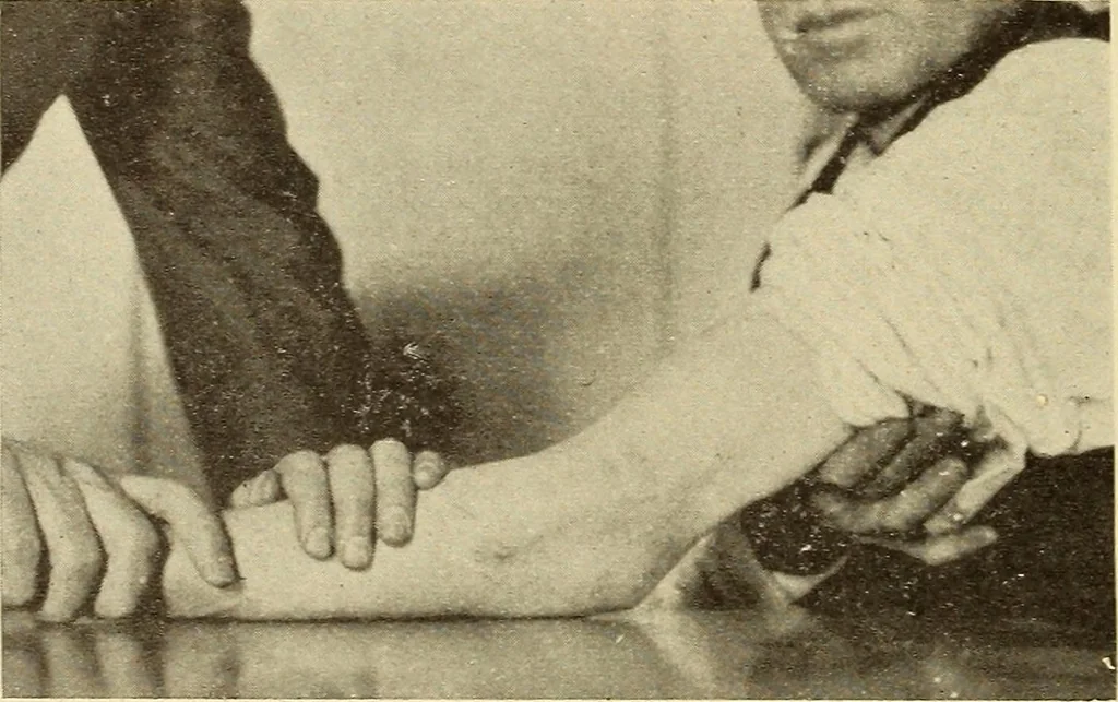An illustration from Fractures and dislocations, diagnosis and treatment, 1915, leaf 167