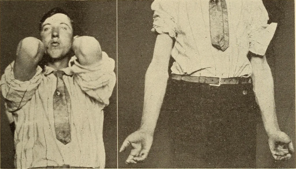 An illustration from Fractures and dislocations, diagnosis and treatment, 1915, leaf 168