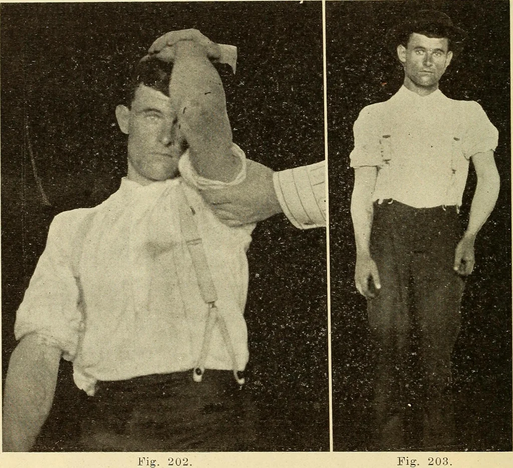 An illustration from Fractures and dislocations, diagnosis and treatment, 1915, leaf 169
