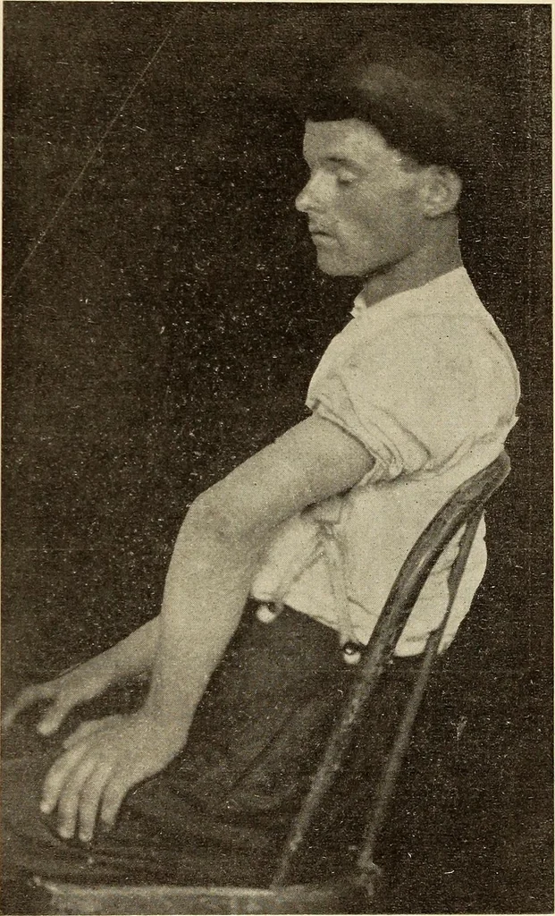 An illustration from Fractures and dislocations, diagnosis and treatment, 1915, leaf 170