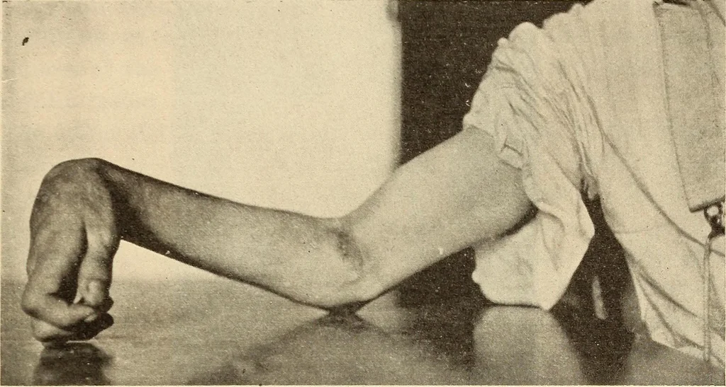 An illustration from Fractures and dislocations, diagnosis and treatment, 1915, leaf 172