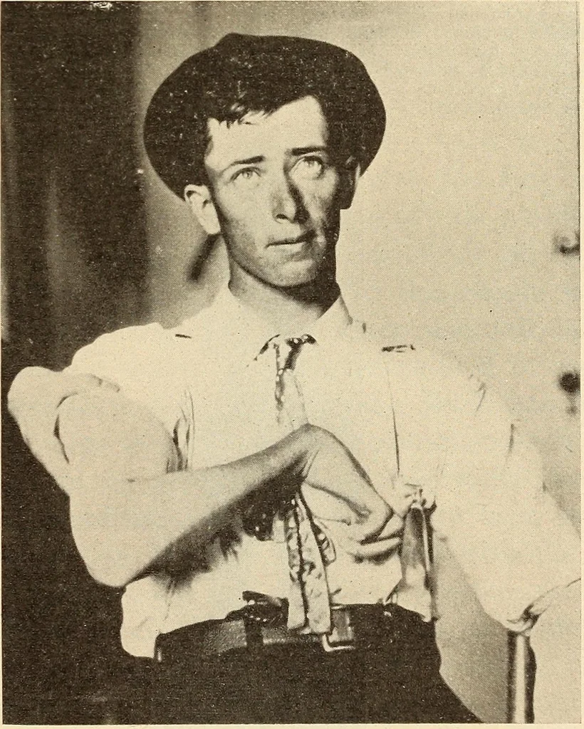An illustration from Fractures and dislocations, diagnosis and treatment, 1915, leaf 172