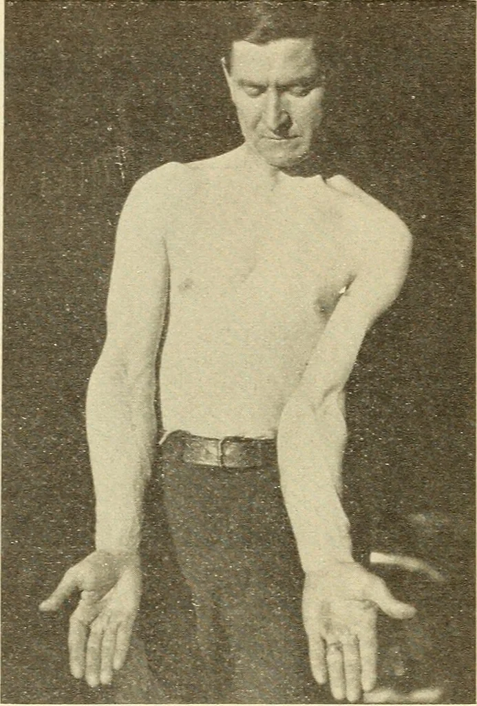 An illustration from Fractures and dislocations, diagnosis and treatment, 1915, leaf 173