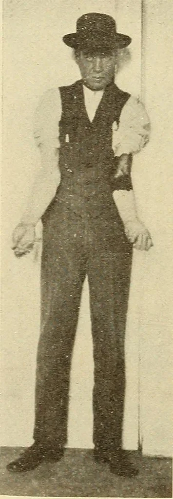 An illustration from Fractures and dislocations, diagnosis and treatment, 1915, leaf 173