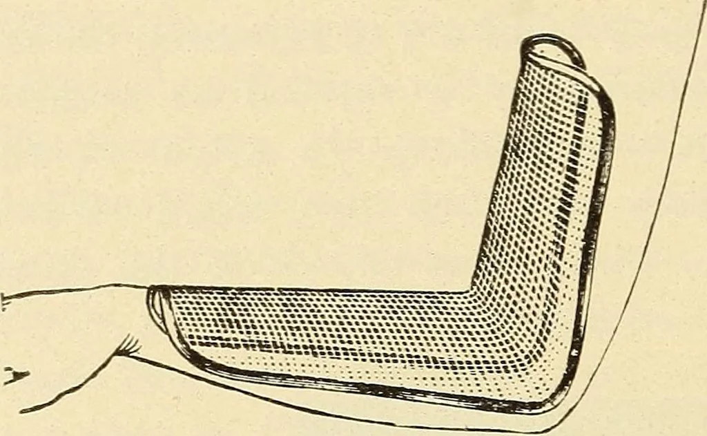 An illustration from Fractures and dislocations, diagnosis and treatment, 1915, leaf 177