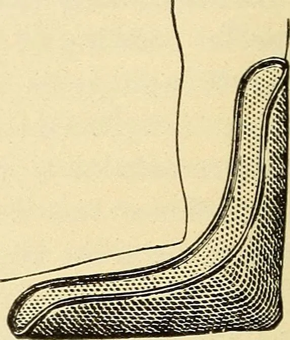 An illustration from Fractures and dislocations, diagnosis and treatment, 1915, leaf 177