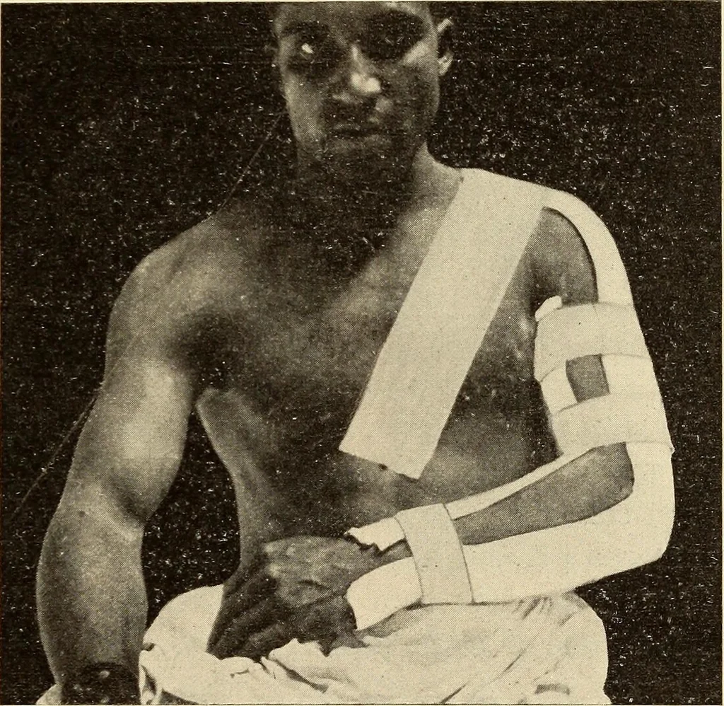 An illustration from Fractures and dislocations, diagnosis and treatment, 1915, leaf 178