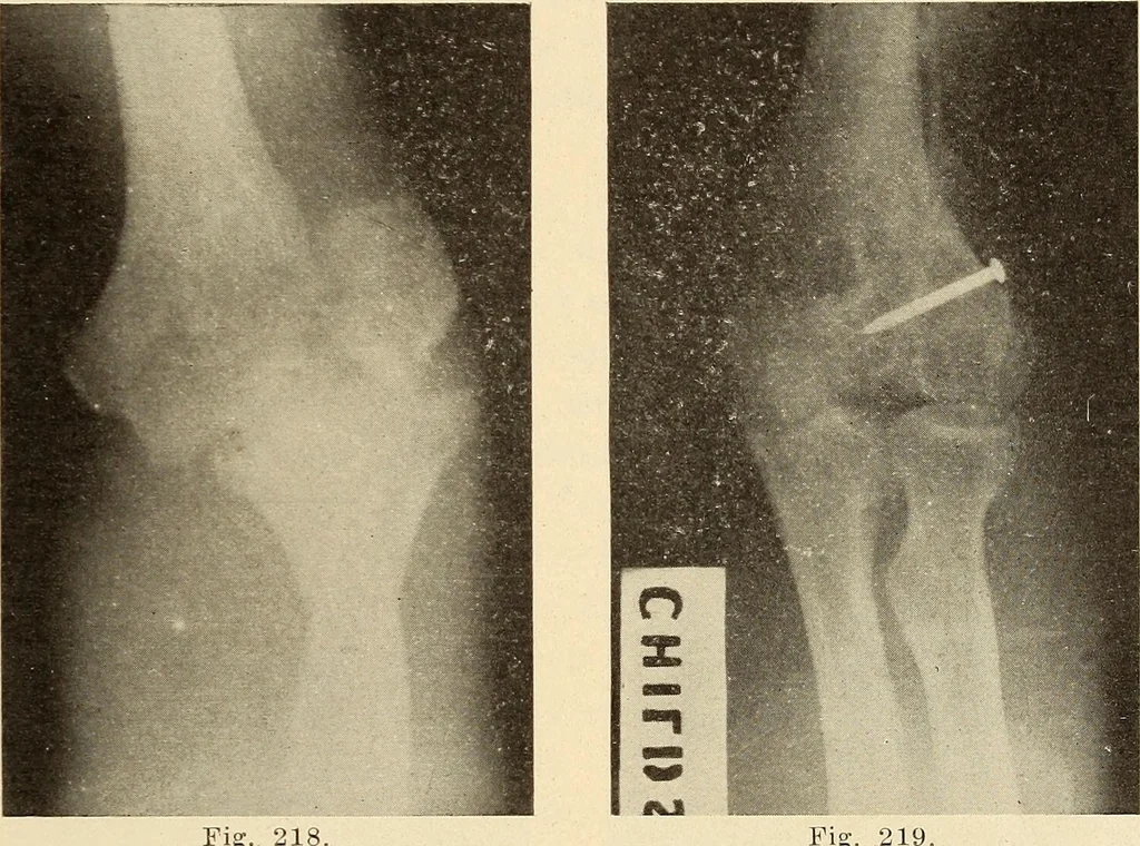 An illustration from Fractures and dislocations, diagnosis and treatment, 1915, leaf 180