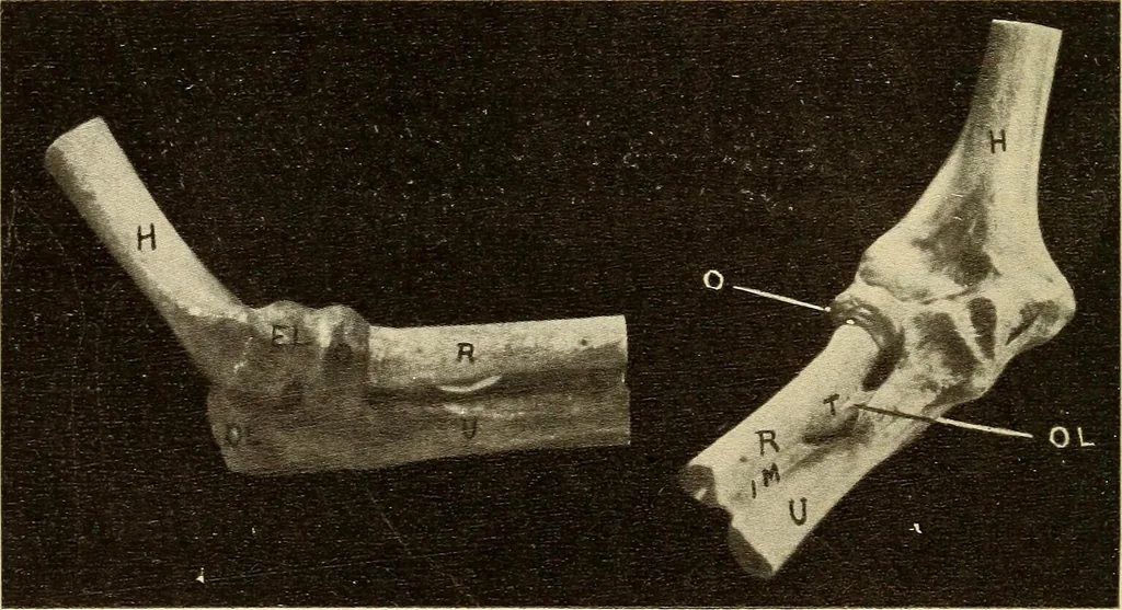 An illustration from Fractures and dislocations, diagnosis and treatment, 1915, leaf 185