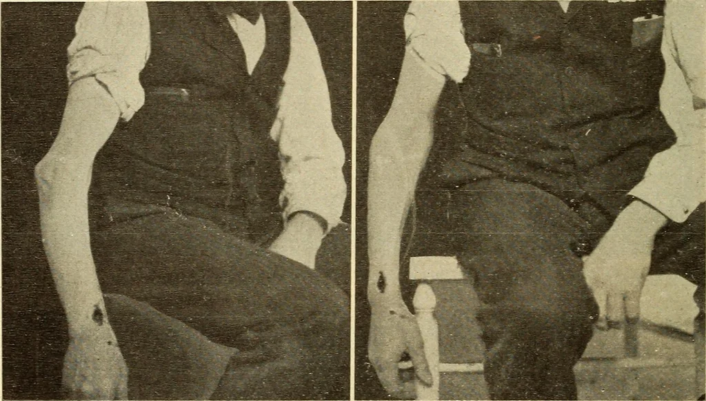 An illustration from Fractures and dislocations, diagnosis and treatment, 1915, leaf 189