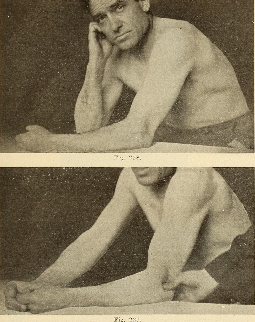 An illustration from Fractures and dislocations, diagnosis and treatment, 1915, leaf 190