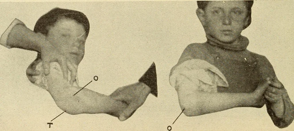 An illustration from Fractures and dislocations, diagnosis and treatment, 1915, leaf 191