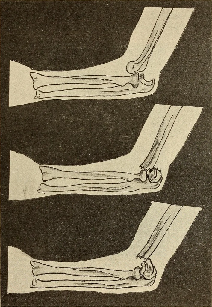 An illustration from Fractures and dislocations, diagnosis and treatment, 1915, leaf 194