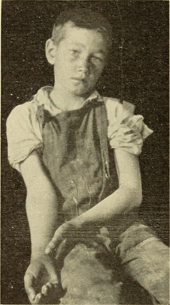 An illustration from Fractures and dislocations, diagnosis and treatment, 1915, leaf 195
