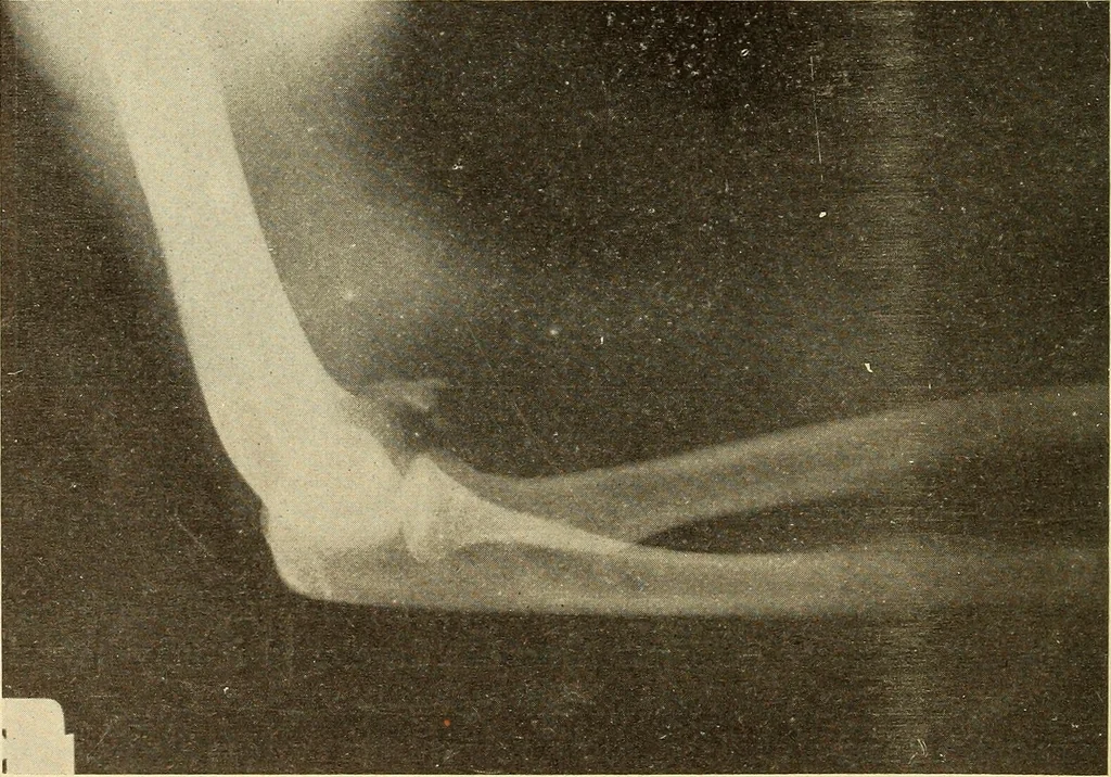 An illustration from Fractures and dislocations, diagnosis and treatment, 1915, leaf 197