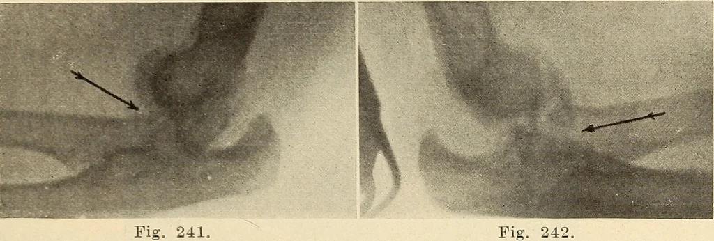 An illustration from Fractures and dislocations, diagnosis and treatment, 1915, leaf 198