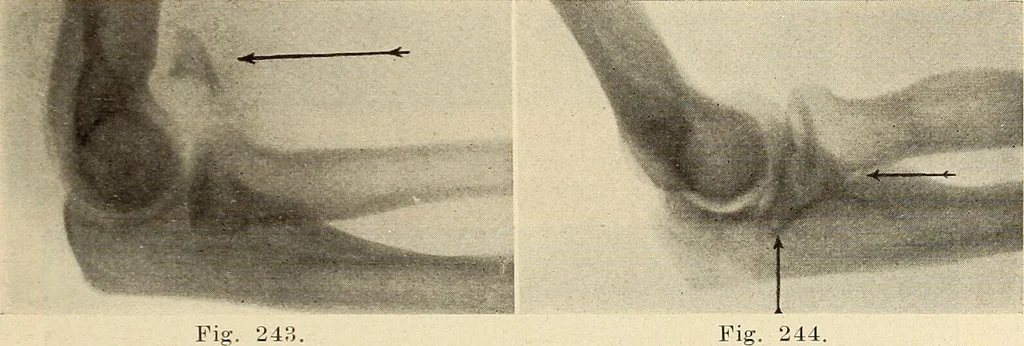 An illustration from Fractures and dislocations, diagnosis and treatment, 1915, leaf 198