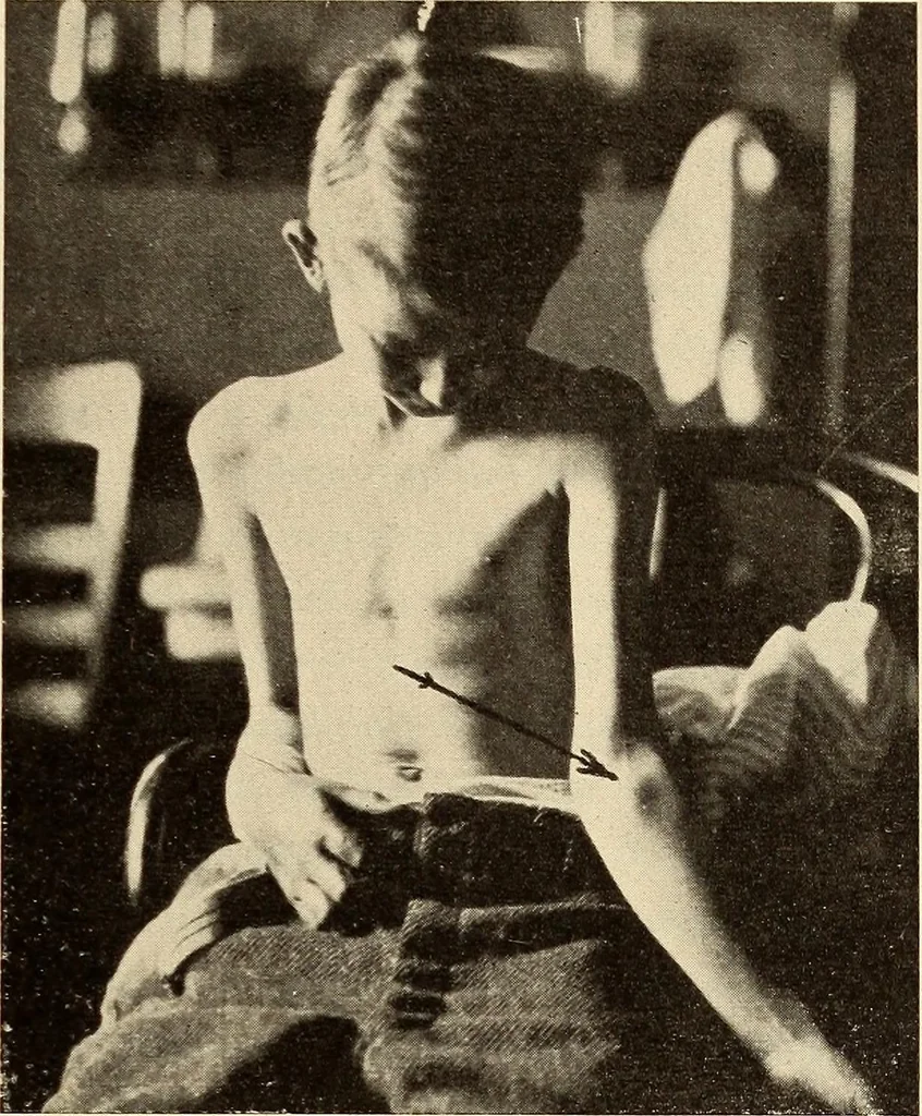 An illustration from Fractures and dislocations, diagnosis and treatment, 1915, leaf 210