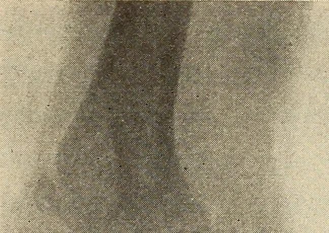 An illustration from Fractures and dislocations, diagnosis and treatment, 1915, leaf 210
