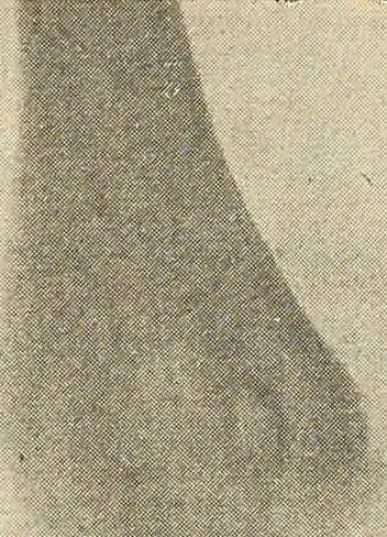 An illustration from Fractures and dislocations, diagnosis and treatment, 1915, leaf 210