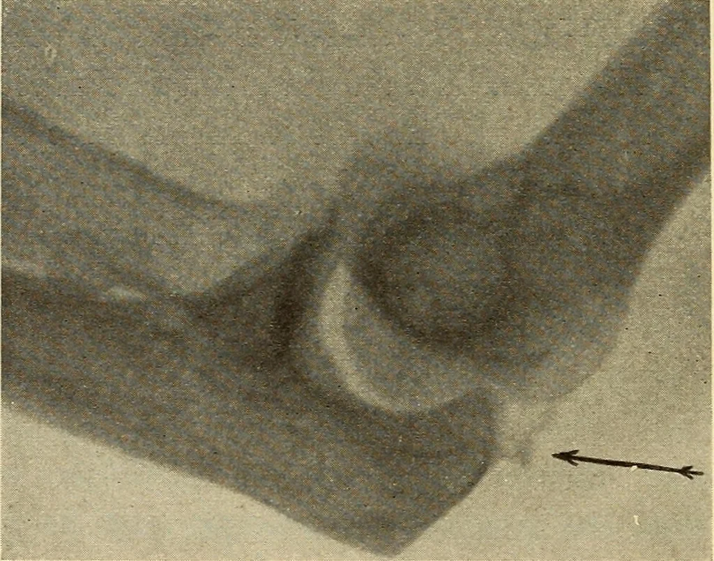 An illustration from Fractures and dislocations, diagnosis and treatment, 1915, leaf 217