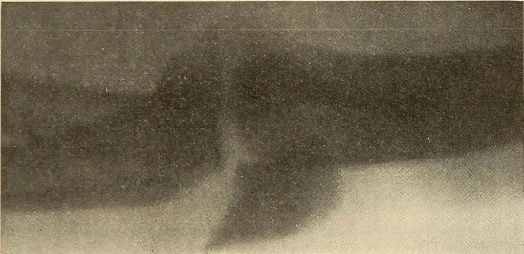 An illustration from Fractures and dislocations, diagnosis and treatment, 1915, leaf 218
