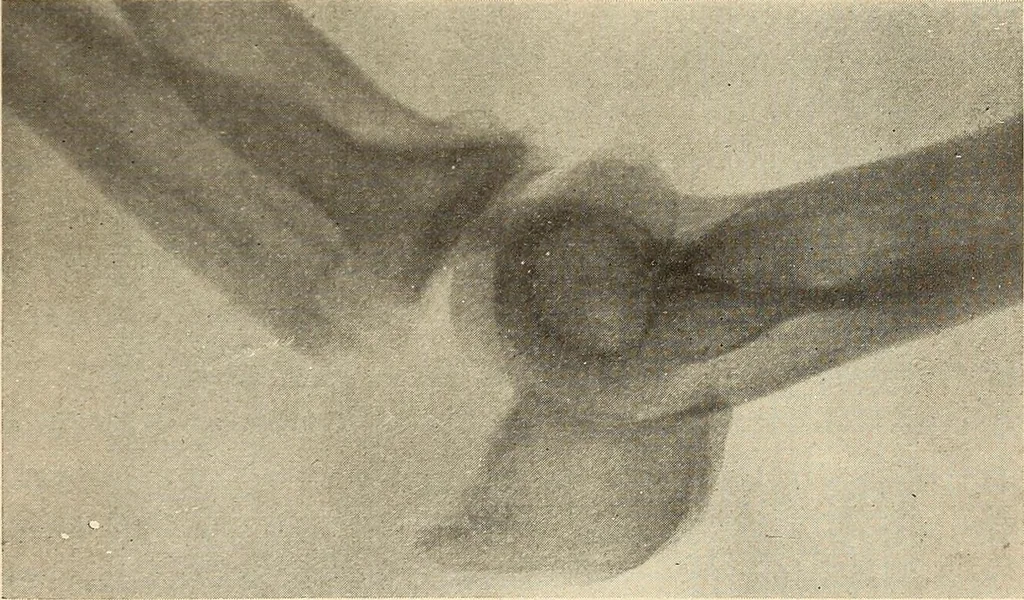 An illustration from Fractures and dislocations, diagnosis and treatment, 1915, leaf 218