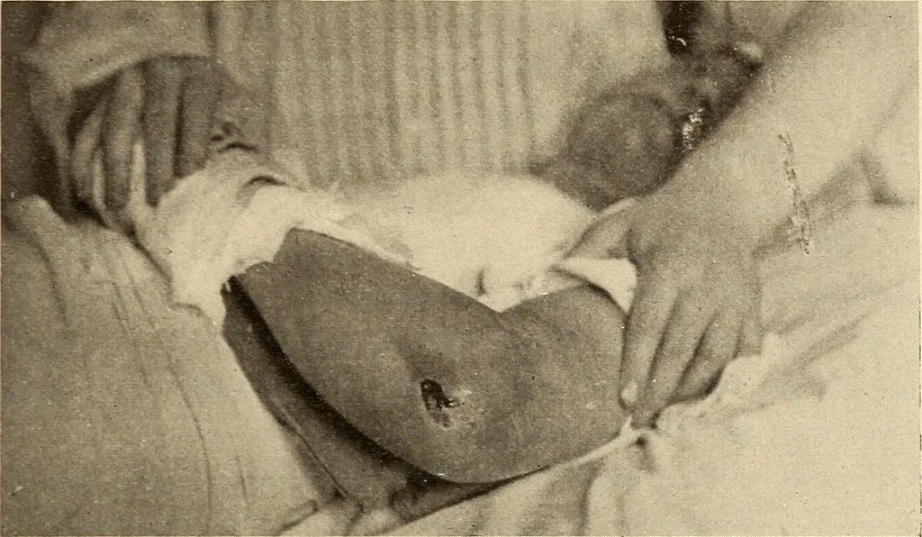 An illustration from Fractures and dislocations, diagnosis and treatment, 1915, leaf 220