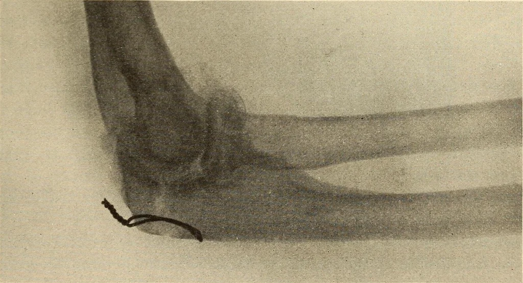 An illustration from Fractures and dislocations, diagnosis and treatment, 1915, leaf 224