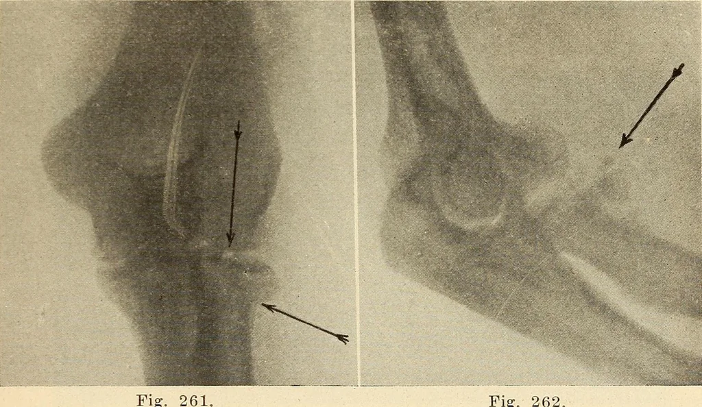An illustration from Fractures and dislocations, diagnosis and treatment, 1915, leaf 228