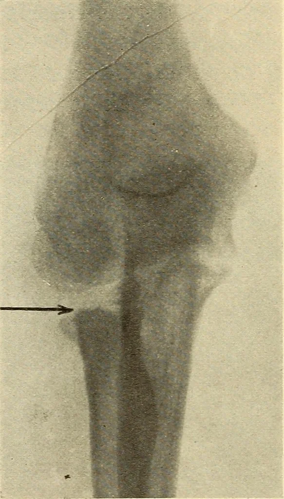 An illustration from Fractures and dislocations, diagnosis and treatment, 1915, leaf 229