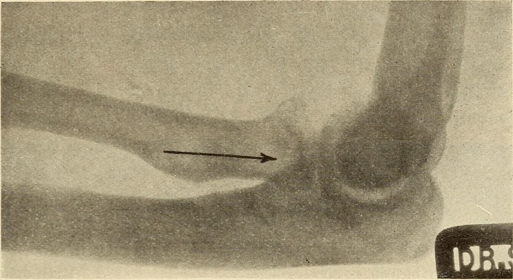 An illustration from Fractures and dislocations, diagnosis and treatment, 1915, leaf 230