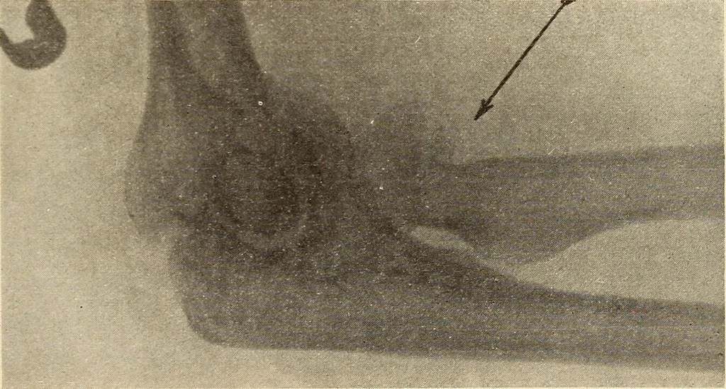An illustration from Fractures and dislocations, diagnosis and treatment, 1915, leaf 230