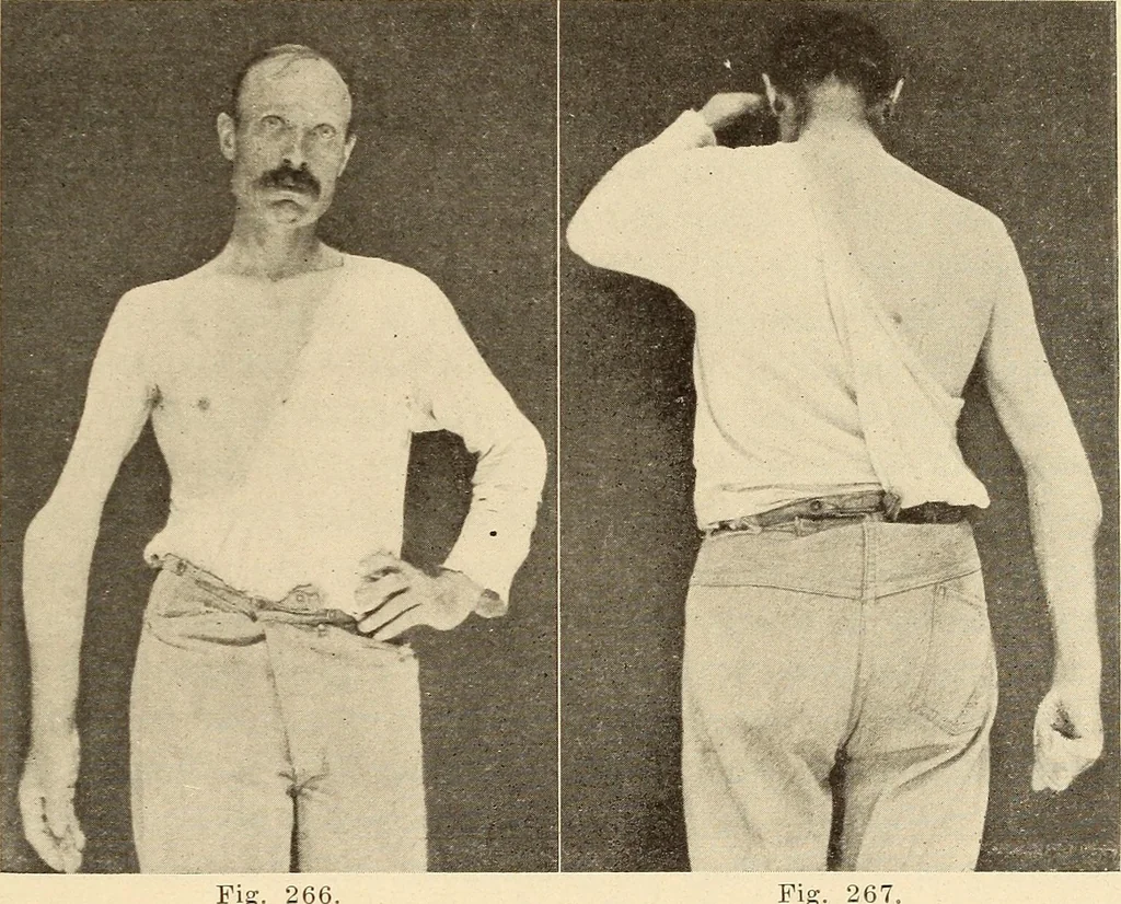 An illustration from Fractures and dislocations, diagnosis and treatment, 1915, leaf 232