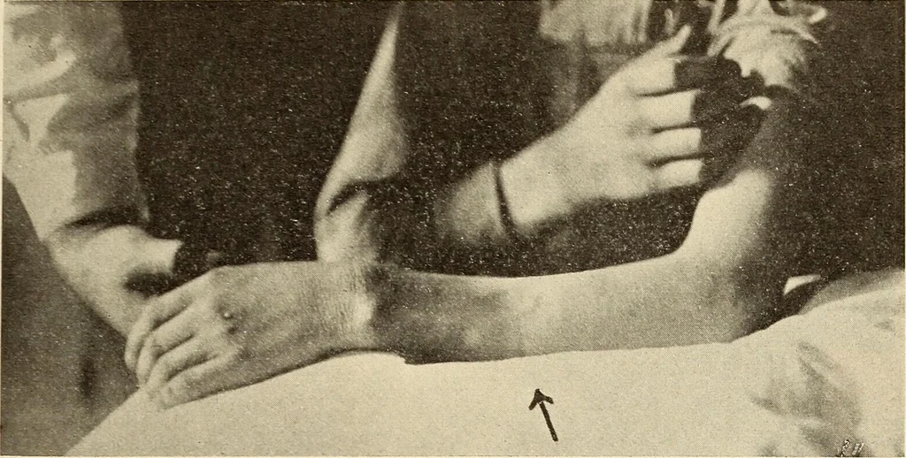 An illustration from Fractures and dislocations, diagnosis and treatment, 1915, leaf 238