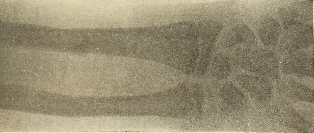 An illustration from Fractures and dislocations, diagnosis and treatment, 1915, leaf 238