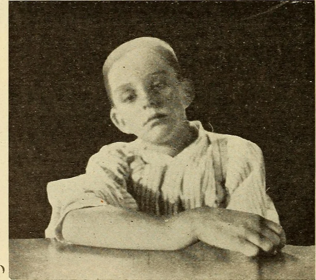 An illustration from Fractures and dislocations, diagnosis and treatment, 1915, leaf 239