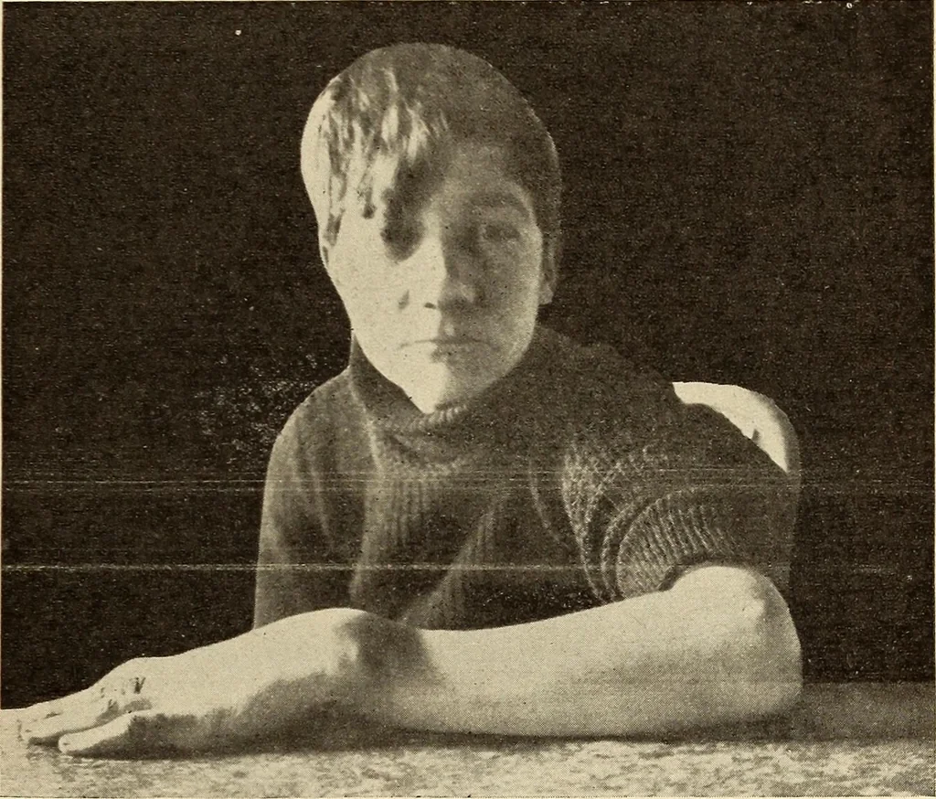 An illustration from Fractures and dislocations, diagnosis and treatment, 1915, leaf 240
