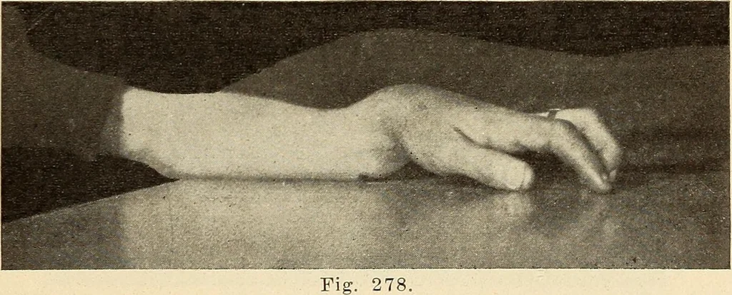 An illustration from Fractures and dislocations, diagnosis and treatment, 1915, leaf 240