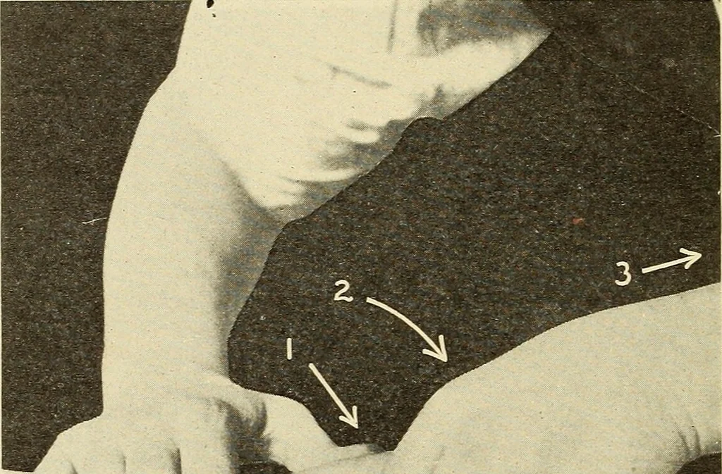 An illustration from Fractures and dislocations, diagnosis and treatment, 1915, leaf 241