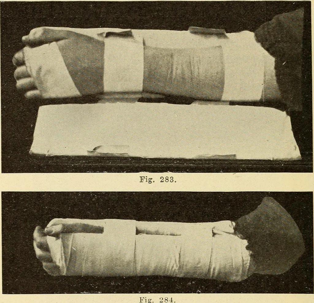An illustration from Fractures and dislocations, diagnosis and treatment, 1915, leaf 243