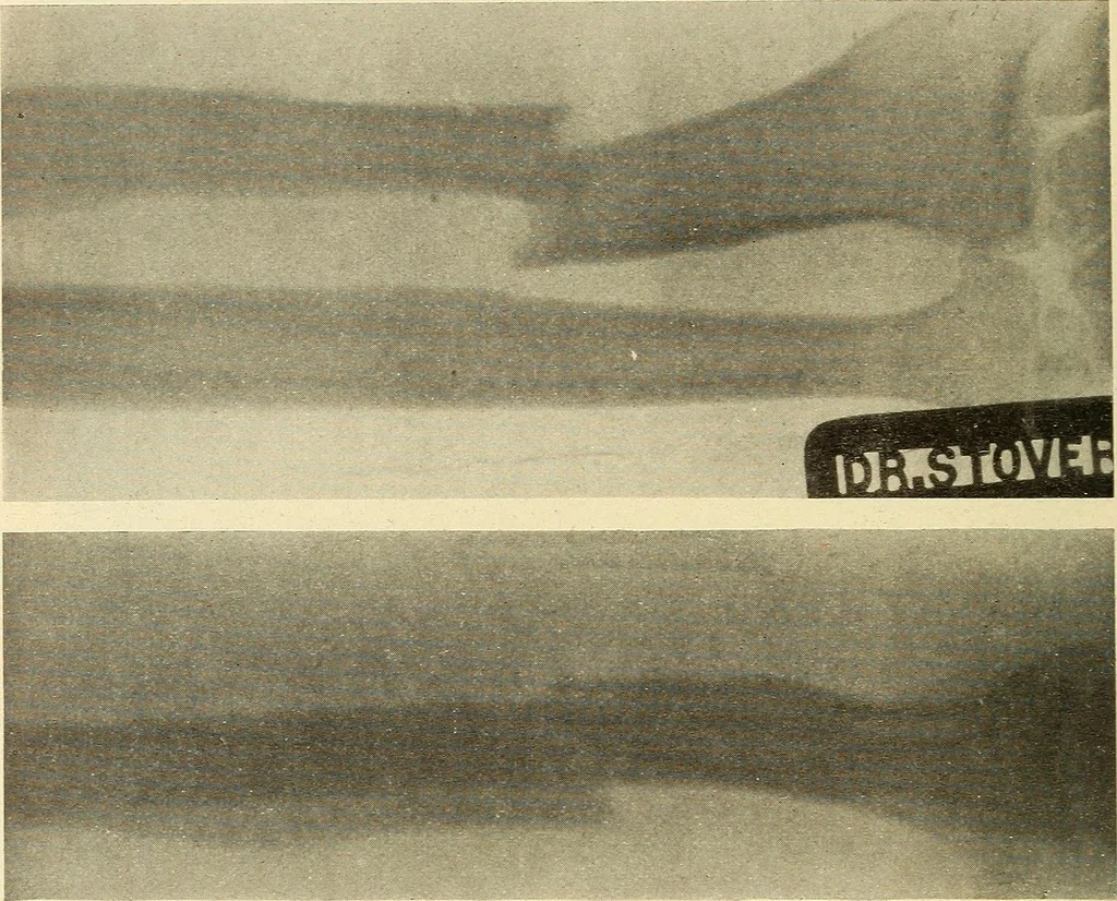 An illustration from Fractures and dislocations, diagnosis and treatment, 1915, leaf 245