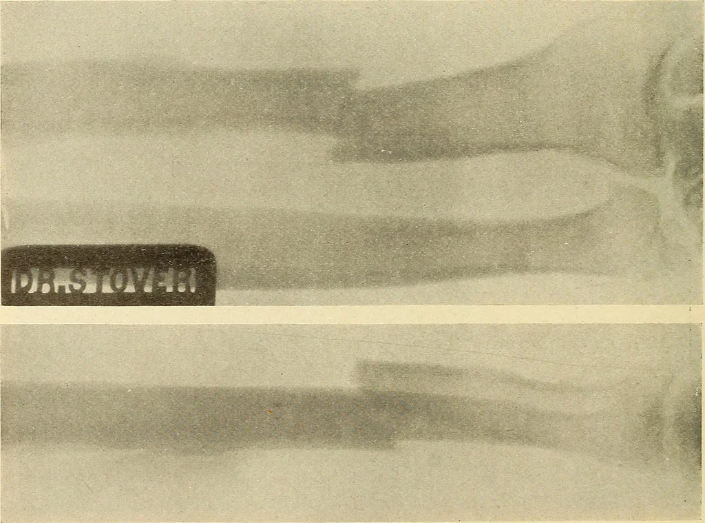 An illustration from Fractures and dislocations, diagnosis and treatment, 1915, leaf 245