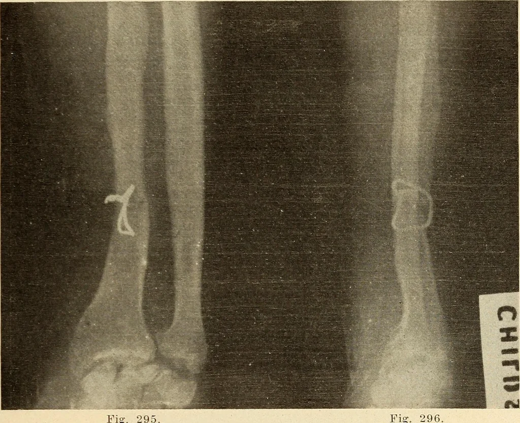 An illustration from Fractures and dislocations, diagnosis and treatment, 1915, leaf 246