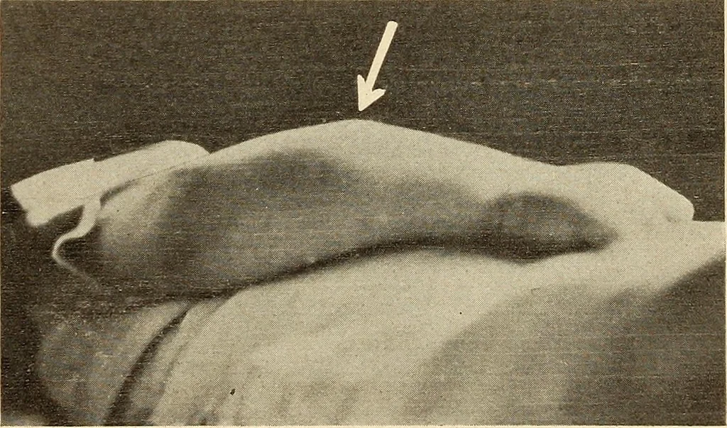 An illustration from Fractures and dislocations, diagnosis and treatment, 1915, leaf 246