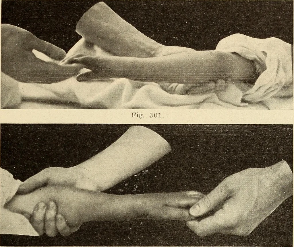 An illustration from Fractures and dislocations, diagnosis and treatment, 1915, leaf 248