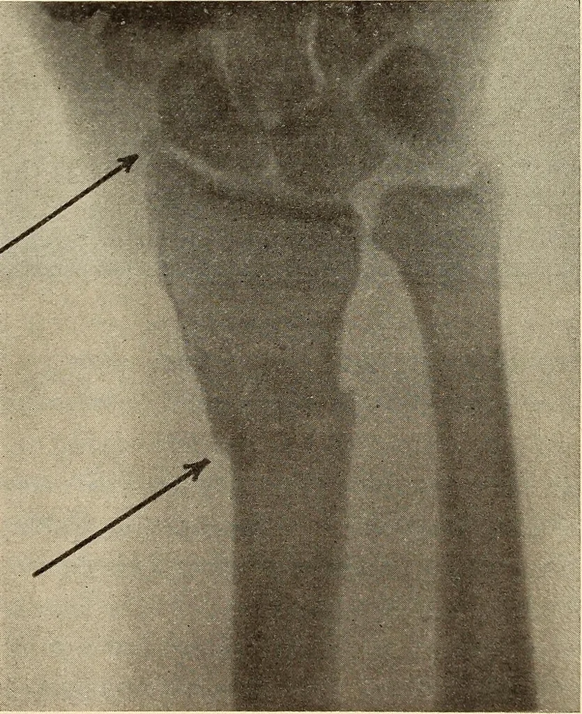 An illustration from Fractures and dislocations, diagnosis and treatment, 1915, leaf 248