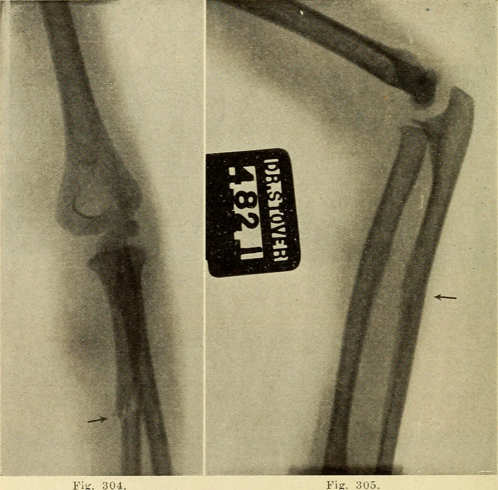 An illustration from Fractures and dislocations, diagnosis and treatment, 1915, leaf 249