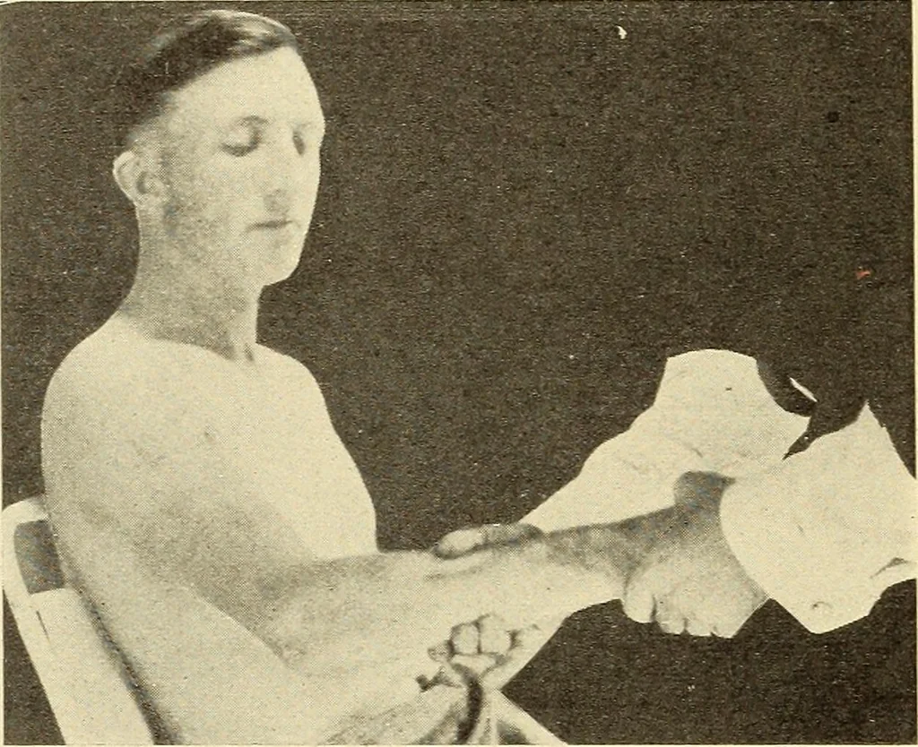 An illustration from Fractures and dislocations, diagnosis and treatment, 1915, leaf 251